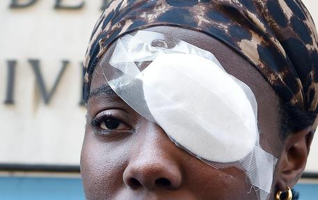 Daisy Osakue giovane atleta di origine nigeriana ferita ad un occhio lanciato da un'auto in corsa a Monclaieri, Torino.
