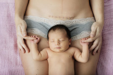 Un neonato appoggiando la testa sulla pancia della mamma con la cicatrice del parto cesareo.