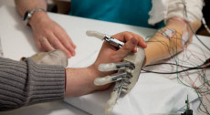 Prima mano bionica impiantata ad una donna