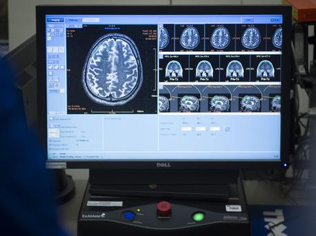 Alzheimer: Nella foto dello Sunnybrook Health Sciences Centre si mostrano i risultati della tomografia al cervello di un paziente