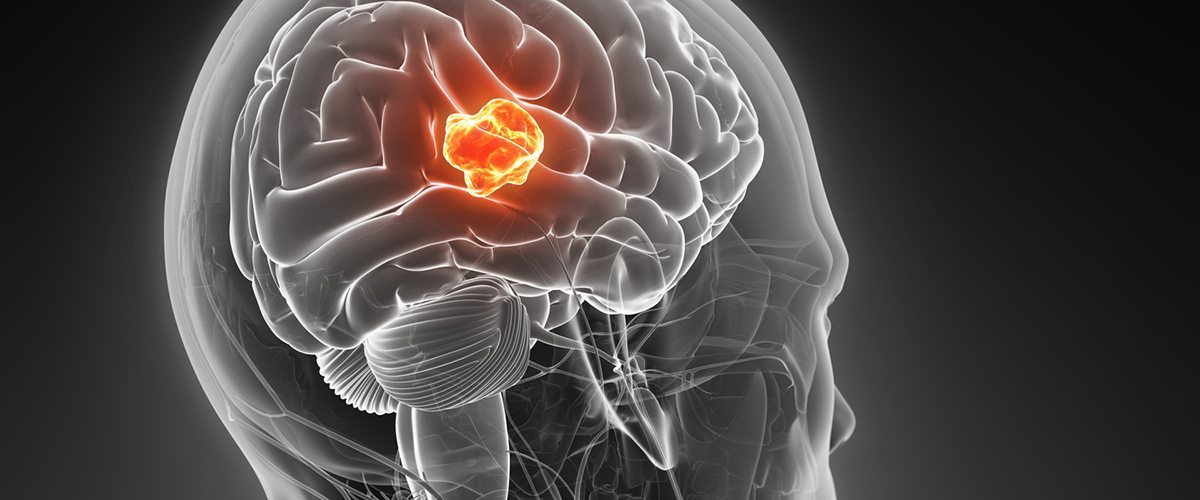 I pericolosi tumori cerebrali chiamati glioblastomi.
