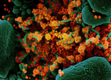Le cellule del coronavirus in arancione al microscopio.