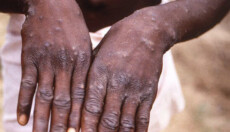 Mani di una persona con sintomi del vaiolo delle scimmie.